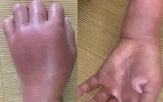 Cảnh báo: Ong đốt có thể nguy hiểm tính mạng