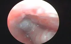 Phát hiện trường hợp giòi ký sinh trong tai trẻ 14 tháng tuổi
