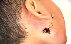 Bệnh nhi 4 tuổi thoát chết vì vi khuẩn “ăn thịt người”