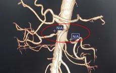 Can thiệp đặt stent động mạch thận điều trị tăng huyết áp kháng trị