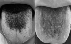 Lưỡi đen bất thường có phải bệnh nguy hiểm?