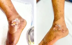 Chủ quan với vết thương nhỏ, người đàn ông suýt mất mạng vì nhiễm khuẩn huyết