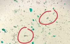 Cẩn trọng với nguy cơ nhiễm sán lá gan từ thói quen ăn cá sống