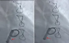 Kịp thời tiêu sợi huyết cứu bệnh nhân bị huyết khối kẹt van tim nhân tạo