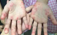 Phát hiện kịp thời bệnh lupus hiếm gặp ở trẻ em