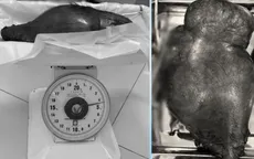 Ròng rã 10 năm mang khối u 4,5kg trong bụng