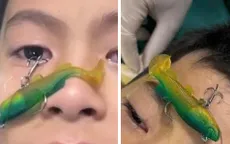 Cứu bé trai bị móc câu cá đâm xuyên nhãn cầu