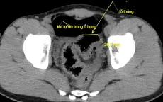 Thủng đại tràng do bị vòi rửa xe xịt vào hậu môn