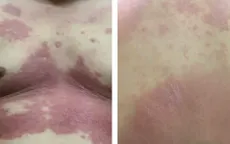 Thuốc sinh học mở cơ hội điều trị hiệu quả viêm khớp vảy nến