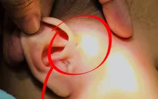 Áp xe thái dương do rò luân nhĩ ở bé gái 6 tháng tuổi