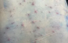 Cứu sống người phụ nữ suy hô hấp nặng do biến chứng thủy đậu