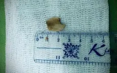 Gắp thành công mảnh xương sắc nhọn mắc trong phế quản bệnh nhân 50 tuổi