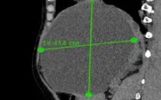 Nang gan: Lành tính nhưng có thể gây biến chứng nếu chủ quan