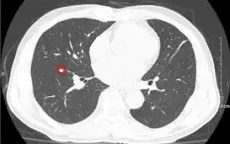 Phát hiện sớm giúp bệnh nhân ung thư phổi U70 nắm bắt "thời điểm vàng" điều trị