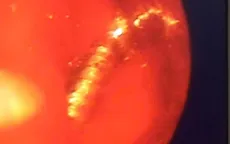 Gắp thành công đinh vít dài trong thực quản bệnh nhân 54 tuổi