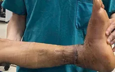 "Chạy đua với thời gian" cứu bàn chân bị đứt rời