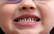 FDA siết chặt việc sử dụng thực phẩm bổ sung fluoride cho trẻ em