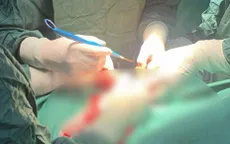 Đau bụng sau 3 ngày, phát hiện u xơ tử cung xoắn phải mổ cấp cứu