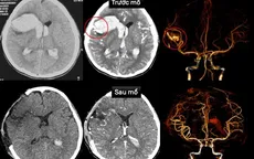 Đang ngủ, bé gái 13 tuổi đột ngột hôn mê do vỡ mạch máu não