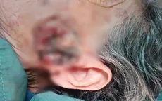 93 tuổi vẫn vượt qua ca mổ ung thư da vùng mặt