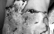 Bệnh nhi 7 tuổi bị bỏng do pháo hoa, phải điều trị gần 1 tháng