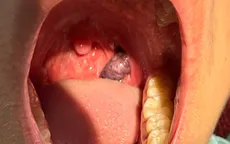 Phẫu thuật lấy khối u máu hiếm gặp vùng họng cho bệnh nhi 14 tuổi