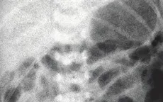 Cứu sống bé trai sinh non 36 tuần bị teo ruột non và thoát vị cuống rốn