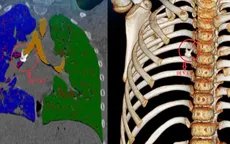 Bé trai 8 tuổi ho kéo dài, bác sĩ phát hiện dị vật là… một chiếc răng trong phế quản