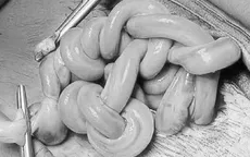 "Tết tóc" bằng dây rốn trong bụng mẹ và cuộc giải cứu hai bé song thai ở tuần 30