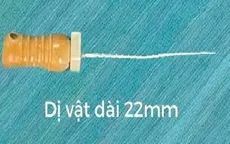 Gắp thành công dị vật kim chọc tủy trong đường thở bé 3 tuổi