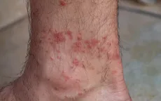 Mỹ ghi nhận ca tử vong đầu tiên liên quan đến dị ứng thịt đỏ do ve cắn