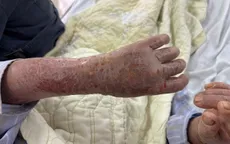 Đắp thuốc lá chữa ngứa, bệnh nhân nhập viện trong tình trạng da bong vảy toàn thân