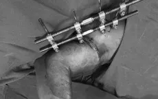 Trồng nối lại cánh tay đứt rời sau tai nạn lao động