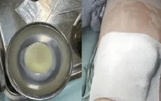 Điều trị thành công ca áp xe cơ phức tạp cho bé gái 2 tuổi