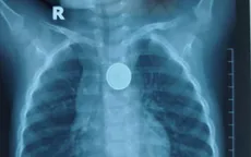 Bé trai 32 tháng nuốt pin cúc áo, bị loét thực quản 