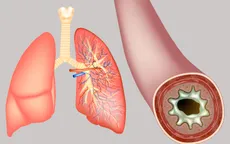 Châu Âu cấp phép thuốc mới điều trị bệnh phổi mạn tính nghiêm trọng NCFB