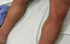 Sốt xuất huyết: Dấu hiệu cảnh báo bệnh chuyển nặng khi cơn sốt vừa qua