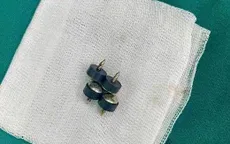 Bé trai 2 tuổi nuốt 4 đinh nam châm đầu nhọn cực nguy hiểm