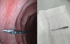 Bé 11 tuổi nuốt kim may, suýt mất mạng vì tai nạn bất ngờ