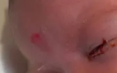 Cảnh báo viêm kết mạc ở trẻ sơ sinh