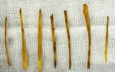 Ăn uống mất tập trung, bé gái 13 tuổi suýt nguy kịch vì nuốt nhiều xương gà