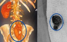 Lấy sỏi thận cho một trường hợp thận lạc chỗ hiếm gặp