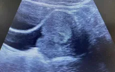 Thiếu nữ 19 tuổi thiếu máu nặng vì polyp âm đạo kích thước lớn