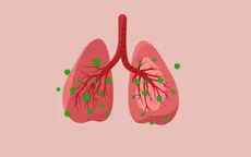 Infographic: Dấu hiệu cảnh báo sớm viêm phổi ở trẻ