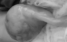 Cứu sống bệnh nhi sơ sinh có khối thoát vị rốn "khổng lồ"