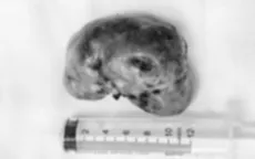 Loại bỏ khối u lớn vùng đầu tồn tại hơn 30 năm cho người đàn ông