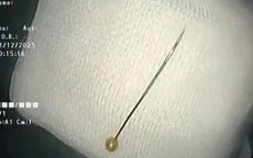 Gắp thành công kim dài 4 cm trong tá tràng bé 11 tháng tuổi