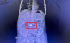 Cảnh báo liên tiếp trẻ nuốt đồng xu nhập viện