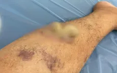 Laser loại bỏ u nhú "hội chứng người cây" cho bệnh nhân