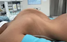 Phẫu thuật 2 trường hợp trẻ bị vẹo cột sống hiếm gặp